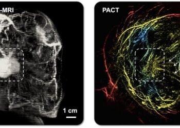 AI-Assisted Technique Offers Safe, Effective, Painless Breast Imaging Alternative
