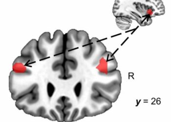 MRI image of a brain
