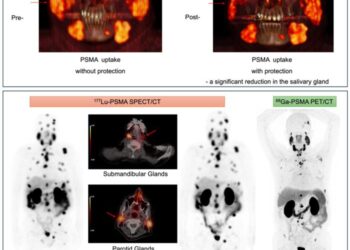 Salivary gland protection with botulinum toxin and scopolamine during tandem PSMA-targeted radioligand therapy.