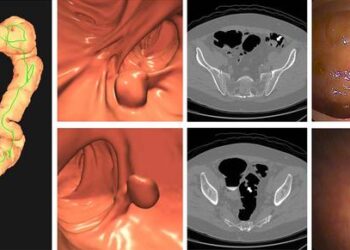 Images of positive CT colonography screening examination result in an asymptomatic 67-year-old man.