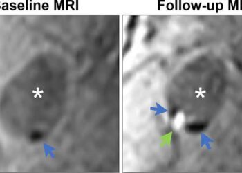 Demonstration of colocalization of pre-existing calcification and incident intraplaque hemorrhage in the same plaque.