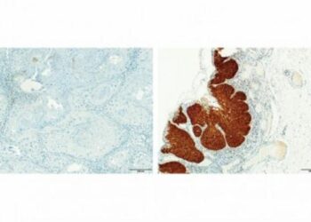 Study finds that common bacteria in the mouth can help predict the progression of head and neck cancer
