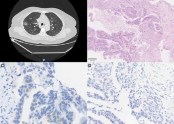 Molecular landscape of HER2-mutated non-small cell lung cancer in Northeastern Brazil: Clinical, histopathological, and genomic insights