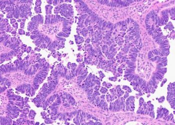 high grade serous carcinoma