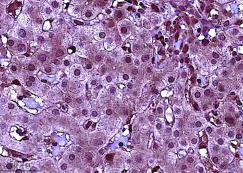 Study Identifies Ways to Lower Risk of Liver Cancer for People with Hepatitis B Infection