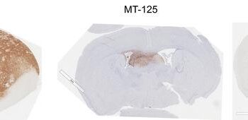 MT-125 and Sutent synergize to attack brain tumors