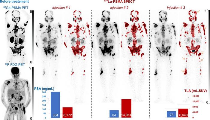 Maximum-intensity projection images from [68Ga]Ga-PSMA and [18F]-FDG PET before treatment, and [177Lu]Lu SPECT displayed without and with (red) segmentation with SUV of >3 in 74-y-old mCRPC patient.”>
                  </div><figcaption class=