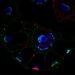 CircSipa1l1 Drives Melanoma Differentiation via IGF2BP1 Pathway