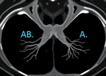 ABCD2 Enhances Carotid Stenosis Diagnosis with CT Angiography