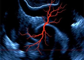 Breakthrough Ultrasound Technology Transforms Microvascular Flow Imaging — Cancer