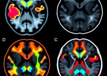Distinguishing Parkinson’s from Essential Tremor via Imaging — Medicine