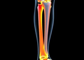 Femoral Fracture Patterns Reveal Southern Brazil Inequalities — Medicine