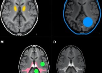 STN DBS fMRI Uncovers Symptom-Specific Brain Networks — Medicine