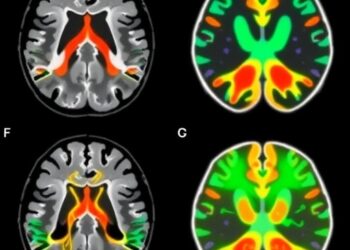 7T MRI Connectivity Enhances Parkinson’s DBS Targeting — Medicine