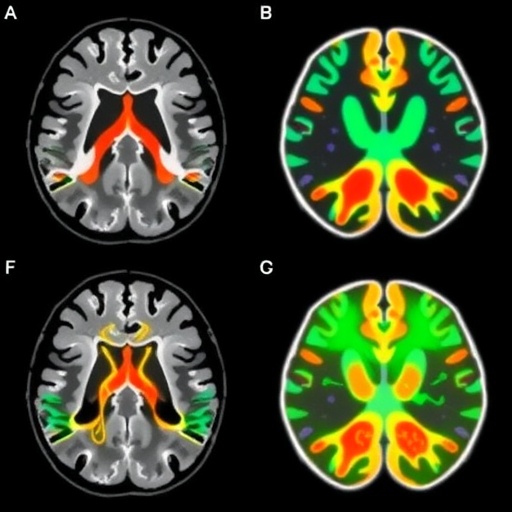 7T MRI Connectivity Enhances Parkinson’s DBS Targeting — Medicine
