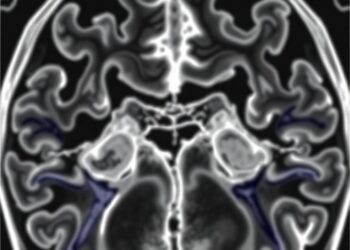 Artery Dilation, Not Blockages, Associated with Common Stroke Risk — Medicine