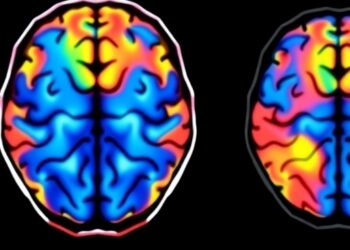 Brain Imaging Study Reveals Ethnoracial Variations in Dementia Risk and Progression — Medicine