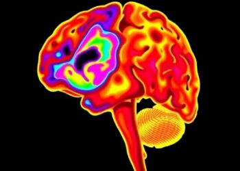 Cerebral NIRS: Key in Managing Post-Hemorrhagic Dilation? — Technology and Engineering