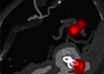 Deep Medullary Vein Thrombosis in Newborns Study — Medicine