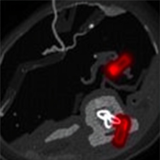 Deep Medullary Vein Thrombosis in Newborns Study — Medicine