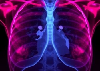ESTRO: Certain Breast Cancer Patients Could Avoid Surgery After Ablative Radiation, Study Suggests — Cancer