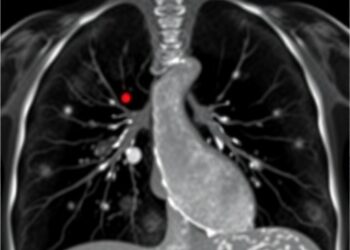 Lung Ultrasound Detects Necrosis in Pediatric Pneumonia — Technology and Engineering