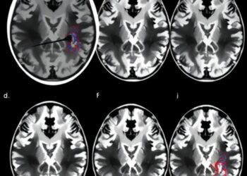 MRI and Transcriptomics Uncover Parkinson’s Neurodegeneration Links — Medicine
