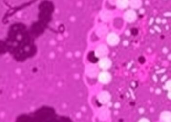 NCOR2 Suppresses MHC I, Fuels Breast Cancer Metastasis — Medicine