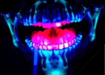 NIR Fluorescence Surgery Enhances Oral Cancer Removal — Medicine
