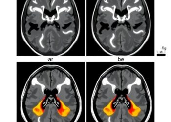 New Insights into Unilateral Meniere’s Disease Patients Lacking Endolymphatic Hydrops via MRI Analysis — Biology