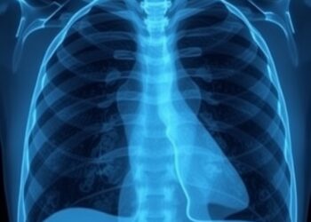 New Study Finds Simple X-Ray Metric Predicts Survival in Lung Cancer Surgery Patients — Cancer