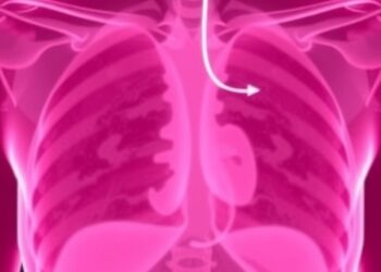 New Study Sheds Light on Predicting Chemotherapy Response in Triple-Negative Breast Cancer — Cancer