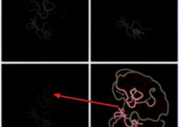 Oligometastatic Prostate Cancer: Linking Local and Metastatic — Medicine