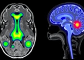 Personalized AI-Guided Radiation Boosts Glioblastoma Treatment — Medicine
