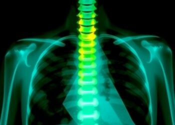 Rare Case of Extraluminal Esophageal Cancer Invading Spine Detected Despite Normal Endoscopy — Cancer