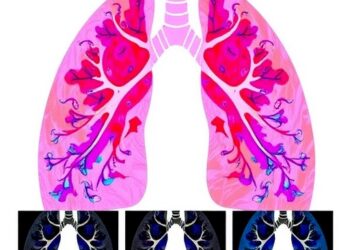 Scientists Identify Seven Distinct Pneumonia Subphenotypes Through Human Lung Analysis — Biology