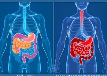 Survival Differences in Early vs. Late-Onset Colorectal Cancer — Cancer