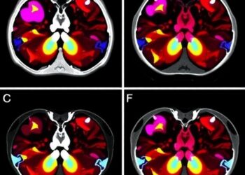 Targeted Radiotherapy Extends Control of Early-Stage Breast Cancer Spread — Cancer