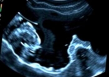 Ultrasound Measures Muscle Size in Preterm Infants — Medicine