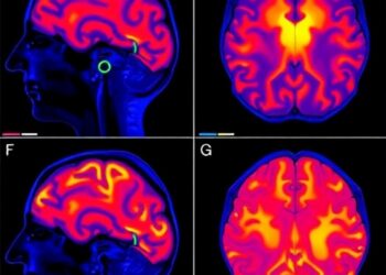 Unraveling Hyperintense FLAIR Signals in Brain Imaging — Medicine