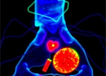 Active β-Catenin Drives Aggressiveness in Pediatric Osteosarcoma, Study Finds — Medicine