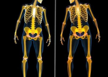 Allergic Diseases Linked to Osteoporosis, Fractures in Elderly — Medicine