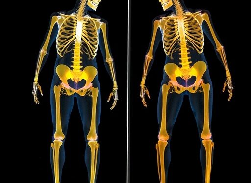 Allergic Diseases Linked to Osteoporosis, Fractures in Elderly — Medicine