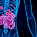 Colon Cancer Cells Can Alter Identity to Enable Metastasis — Medicine
