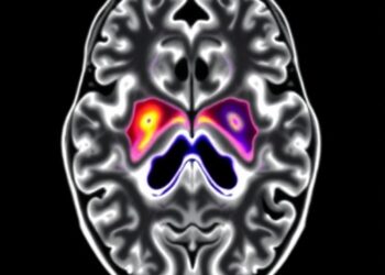 DTI-ALPS and Choroid Plexus Linked to Parkinson’s Severity — Medicine