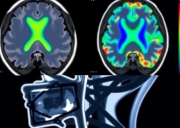Enhancing CNS Tumor Therapy with MRI-Guided Ultrasound — Cancer