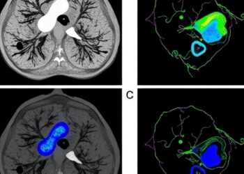IL11 Drives Lung Cancer Metastasis Through MMP12 Pathway — Medicine
