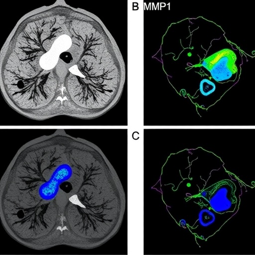 IL11 Drives Lung Cancer Metastasis Through MMP12 Pathway — Medicine