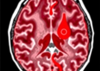 Inflammation Resolution Failure in Intracerebral Hemorrhage — Medicine