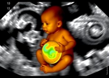 Innovative Noninvasive Method Shows Promise for Early Detection of Dangerous Intestinal Disease in Preterm Infants — Technology and Engineering